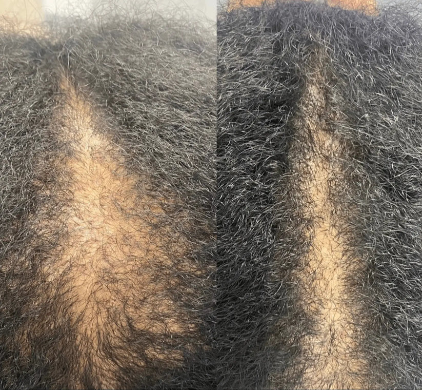 Scalpure™ VitalBrush